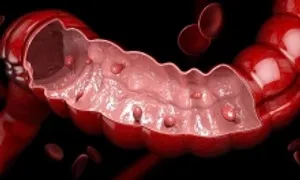 Hàng trăm polyp chi chít đại tràng nam thanh niên Hàng trăm polyp chi chít đại tràng nam thanh niên