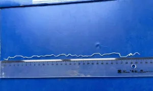 Giun rồng - bệnh hiếm thế giới xuất hiện nhiều tại Việt Nam Giun rồng - bệnh hiếm thế giới xuất hiện nhiều tại Việt Nam