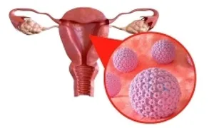 Phụ nữ độ tuổi nào cần tầm soát ung thư cổ tử cung?