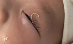 Mẹ cắt móng tay văng vào mắt con gây xuất huyết Mẹ cắt móng tay văng vào mắt con gây xuất huyết