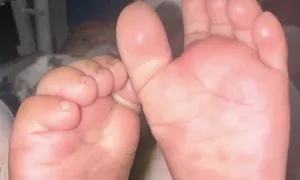 Bé 4 tháng tuổi mắc giang mai Bé 4 tháng tuổi mắc giang mai
