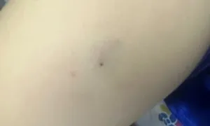 Bé trai bị ong ruồi đốt gây sốc phản vệ Bé trai bị ong ruồi đốt gây sốc phản vệ