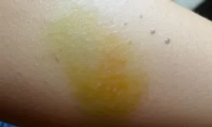 Dấu hiệu trên da, móng cảnh báo viêm gan C