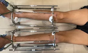Sự thật phía sau các cuộc phẫu thuật kéo dài chân