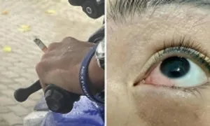 Bỏng mắt vì tàn thuốc văng trúng khi lái xe